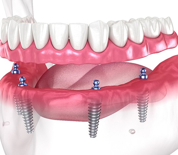Implant dentures in Channahon