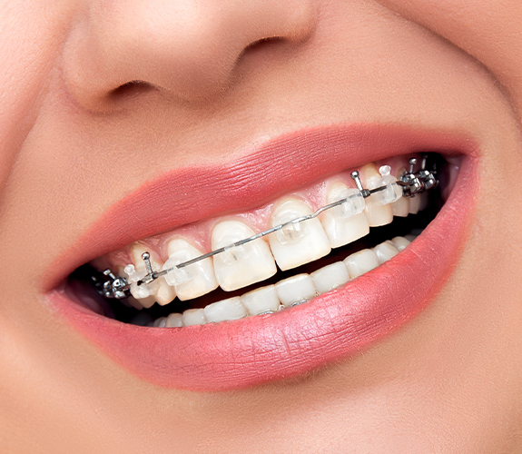 Closeup of tooth colored braces on teeth