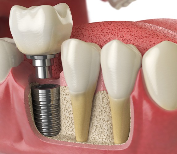 Different parts of a dental implant